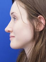 Nasal Profile Irregularity 2611