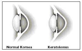 Keratokonus Tedavi Yontemleri 1 Crosslink 2 Intacs Korneal Halka Yontemi 3 Keratoplasti Kornea Nakli Yontemi Korn Lime