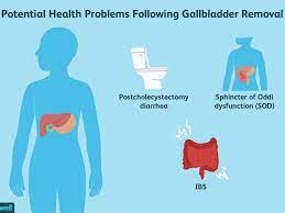 What To Do About Ibs After Gallbladder Removal