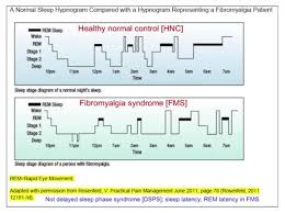 Sleep Hypnogram Healthy Compared To Fibromyalgia Fibromyalgia Rem Sleep Fibromyalgia Syndrome