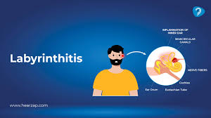 Image result for Bacterial Labyrinthitis