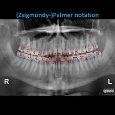 • symbolic system • in this system the arches are divided into quadrants. Palmer Notation Radiology Reference Article Radiopaedia Org