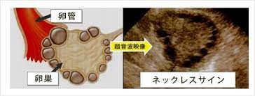 多嚢胞性卵巣 pcoとpcos 卵巣過剰刺激症候群 セントマザー産婦人科医院 嚢胞 産婦人科 卵巣