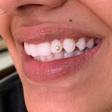 Will the gems damage my teeth? Houston Tooth Gems Battle Royale Tattoo