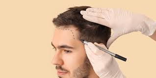 hair transplant cost