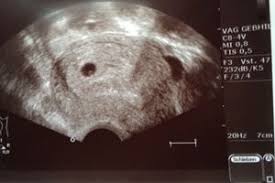 Mein fa meinte, dass es ein eckenhocker sein könnten und ich soll in einer hallo, ich hatte heute einen ultraschall. Missed Abort 6 0 Fruchthohle Mit Dottersack Zu Sehen Aber Kein Embryo Urbia De