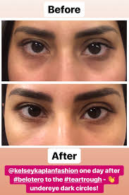 Get Rid of Dark Circles with Belotero