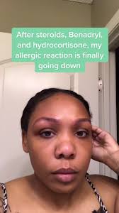 Eyebrow Tint Allergic Reaction Treatment