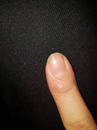 schwarzer streifen auf nagel gesundheit nagel