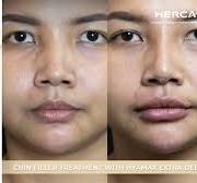 Hyamax® Extra Deep for Chin - HERCA