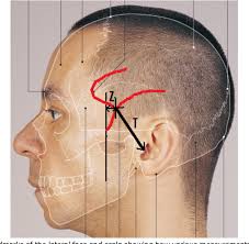 After branching off the maxillary artery in the infratemporal fossa, it. Figure 1 From Variant Anatomy Of Intracranial Part Of Middle Meningeal Artery In A Kenyan Population Semantic Scholar