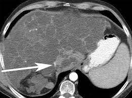 Polycystic Liver Disease Multimodality Imaging For Complications And Transplant Evaluation Radiographics