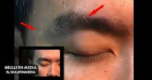 Gambarajah no.1 menunjukkan sarang resdung yang baru dicuci. Video Akibat Makan Babi Ulat Keluar Dari Muka Jangan Tonton Jika Lemah Semangat