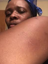 Bed bugs ruined my trip