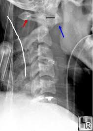 Atlanto Axial Subluxation Operative Neurosurgery