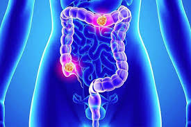 Hsp may also cause gastrointestinal vasculitis causing abdominal pain and melaena, due to bowel wall oedema, haemorrhage, and rarely, bowel infarction, perforation and intussusception. Braemar Endoscopy Services Braemar Hospital