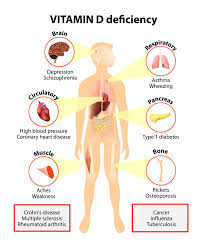 Infections lasted two days longer for those taking the high dose versus the low dose. Vitamin D Deficiency After A Catastrophic Injury Specialist Nutrition Rehab