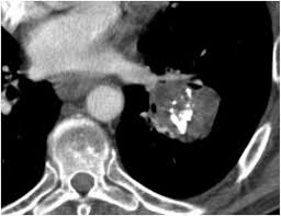 The hamartoma is the dark circular object on the left that dominates the image. Pulmonary Hamartoma A Contrast Enhanced Ct Image Through The Lower Download Scientific Diagram