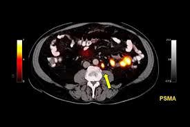 The psa test is a very effective way of checking how successful your treatment has been. New Imaging Method Is More Effective At Detecting Prostate Cancer Recurrence Than Standard Scan Ucla