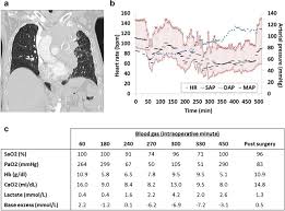 Evo/vob/mpg, mkv/mka, mp4/mov, ts, m2ts to ts to m2ts. Hypoxemia During One Lung Ventilation Does It Really Matter Springerlink