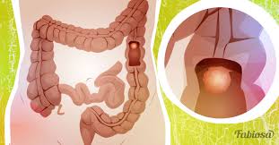 Seek the advice of a doctor if you have any concerns about abdominal discomfort or changes in bowel habits. You Asked Is It Just Irritable Bowel Syndrome Or Colon Cancer How To Tell The Two Apart