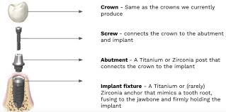 Image result for dental implant
