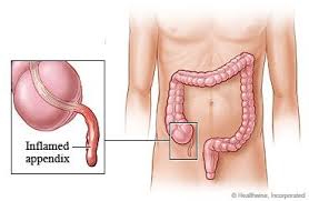 Appendectomy What To Expect At Home Kaiser Permanente Surgery Recovery Appendectomy Recovery Appendicitis Recovery