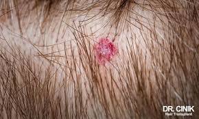 Image result for sores on the head in children