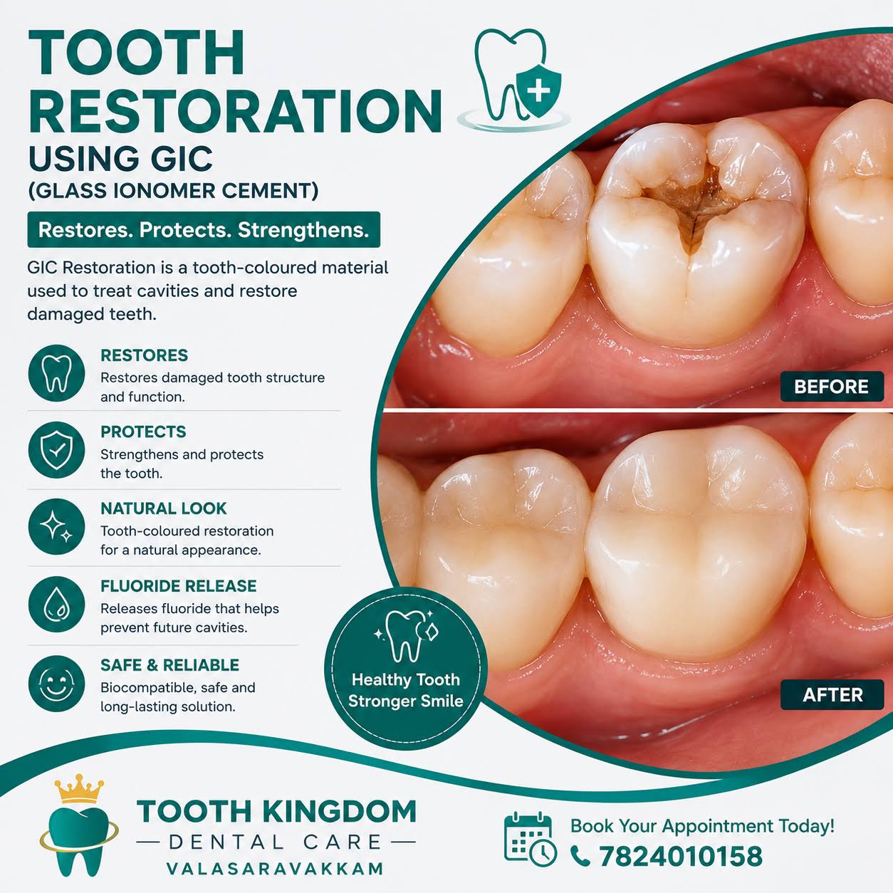 Teeth Cavity Fillings
