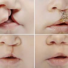 Image result for Cleft Lip