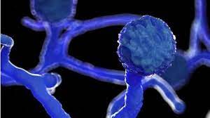 Algunos pacientes solo han podido ser salvados al extirparles un ojo. Hongo Negro Detectan Un Caso De Mucormicosis En Alguien Infectado Con Covid 19 En Uruguay Bbc News Mundo
