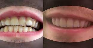 A College Student Made His Own Diy Braces For 60 And His Teeth Look Awesome Diy Braces Diy Teeth Straightening Straight Teeth Without Braces