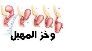 الوخز المهبلي أسبابه وهل يعتبر خطر عليك ll تعرفي على ذلك youtube