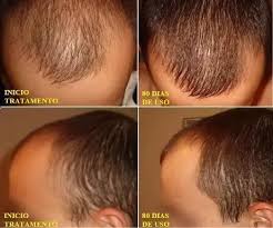 To be 2chic ® : Will Using Minoxidil 2 Solution For Hair Have Any Side Effects Does It Really Work For Hair Growth Quora