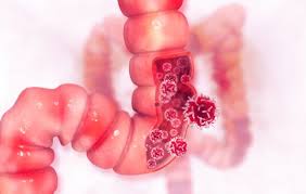 Common symptoms of anemia include skin pallor (paleness), increased heart rate, fatigue, dizziness and irregular menstruation. Surprising Colon Cancer Signs Symptoms To Look Out For Direct Endoscopy