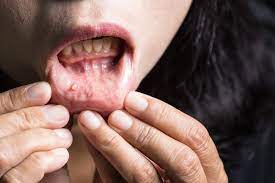 Causes of mouth and tongue cancer. Mouth Cancer Causes Symptoms Treatment Safar Medical
