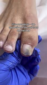 Image result for Onycholysis feet