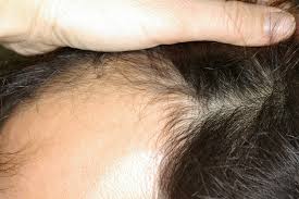 Perte de cheveux chez la femme à genève ou alopécie androgénétique féminine,. Dermato Info L Alopecie