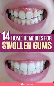 It also reduces the inflammation of your gums and soothes the tender skin. 14 Home Remedies To Treat Swollen Gums Causes And Prevention Swollen Gum Swollen Gums Remedy Gum Inflammation