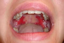 Image result for Canker sores symptoms roof of the mouth