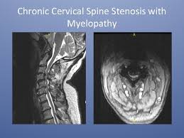 Osteoarthritis Lumbar Spine Icd 10