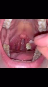 Image result for Tonsillolith