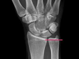 Beurteilung der ligamentären begleitverletzungen des triangulären fibrokartilaginären komplexes (tfcc) und der interkarpalen bänder und ggf. Ulna Impaction Syndrom Ordination Dr Kitzinger