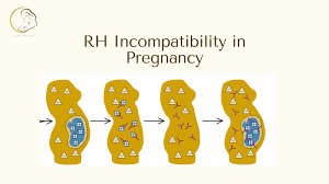 Image result for Rh Sensitization