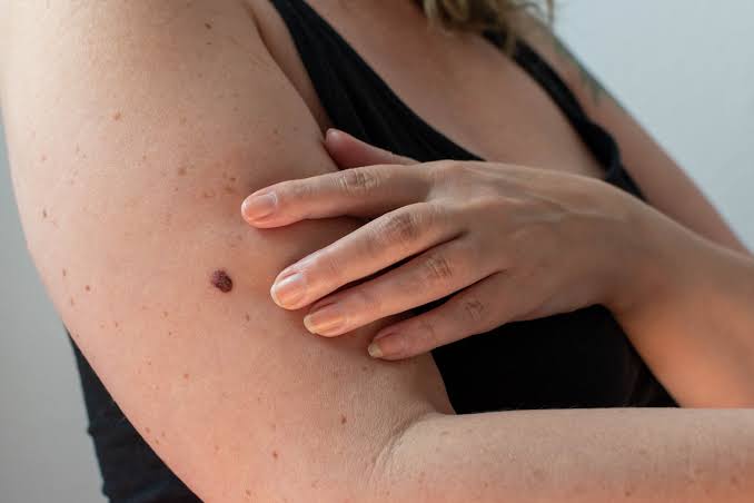 Mole or Melanoma? Tips for Spotting Skin Cancer | WWMG Blog