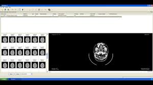 Invesalius is internationalized (currently available in english. Invesalius Open Source 3d Medical Imaging Reconstruction Program