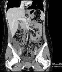 Benign peritoneal cystic mesothelioma (bpcm) is a rare disease entity that arises from mesothelioma cells. Recurrent Benign Multicystic Peritoneal Mesothelioma Approach To This Rare Condition Sciencedirect