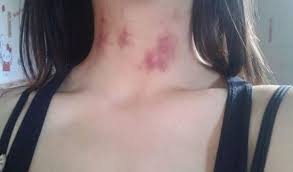 There's surprisingly little research done on hickeys, but the general consensus is that they last about one to two weeks. Quick Guide On How To Get Rid Of A Hickey With Chapstick Bright Stuffs