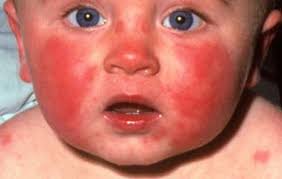 Rashes in Children