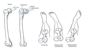 Image result for Femoral Retroversion